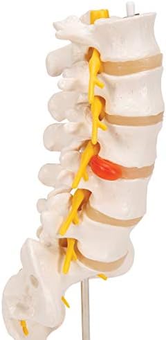 3B Scientific A76/5 Bel Omurga Sütunu, Dorso-Lateral Prolapsed Intervertebral Disk, 34 cm Yükseklik