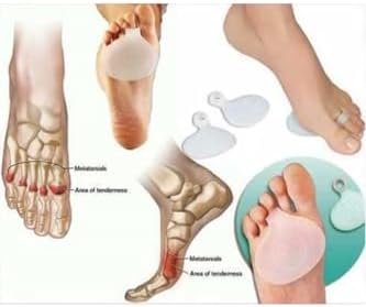 Silikon Metatarsal Ped Ayak Altı Ağrı Nasır Koruma Parmağa Halka