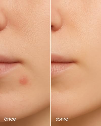 StopEver Clearly Spot Patch, Sivilce Karşıtı Şeffaf Plaster 2'li Paket | Ultra İnce, Hidrokolloid + Niacinamide + Salicylic Asit İçerikli Akne Karşıtı Yüz Bandı | 48 adet (2 x 24)