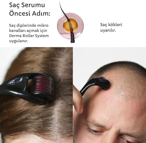 Alternative view of Netmarkt Derma Roller, 540 İğneli Cilt Yenileme Masaj Aleti, Siyah, Mikro İğneleme Sistemi 0,5mm