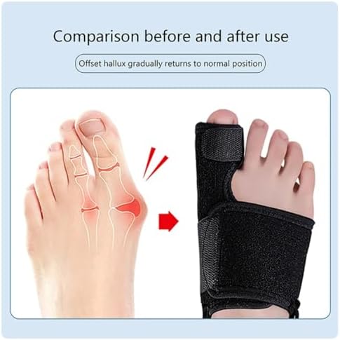 Alternative view of Ayak Başparmak Kemiği Çıkıntısı Düzeltici Medikal Halluks Valgus Ayak Sağlığı Sağ-Sol 2 Parça